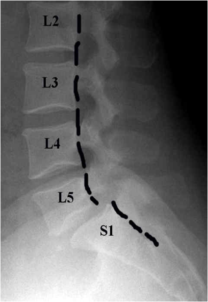   لیز خوردن مهره کمری (SPONDYLOLISTHESIS) 
*لیز خوردن مهره بالایی بر روی مهره پایینی که چهار درجه دارد
*گرید چهار شدیدترین حالت است که نیاز به جراحی دارد
S1 بر روی L5*شایع ترین حالت لیز خوردن 
*لیز خوردگی ها به خصوص درجات شدید آن باعث فشار به عناصر عصبی 
