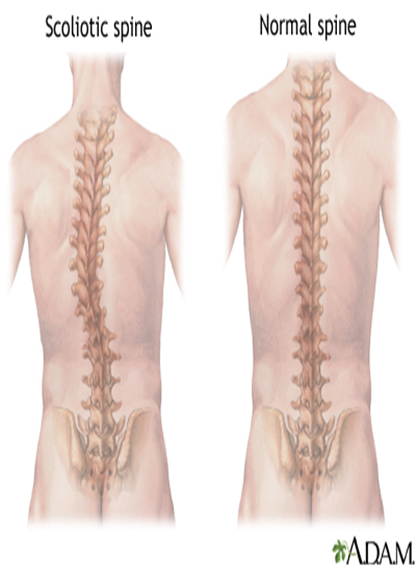 انحراف جانبی ستون فقرات(SCOLIOSIS) دو قوس غیرنرمالS TYPE* یک قوس غیر نرمالC TYPE* میزان قوس در افراد مبتلا متفاوت میباشد که خود نوعی از درجه بندی را ایجاد میکند ):برگشت پذیرMOBILE)*غیر ساختمانی (FIXED)*ساختمانی