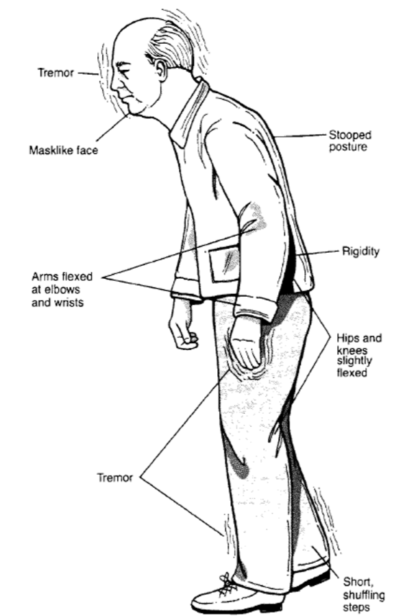 تشخيص پارکینسون ایستادن راه رفتن پارکینسون تمرینات ورزش های پارکینسون مراحل پارکینسون علائم پارکینسون پارکینسون,تشخيص,درمان و پیشگیری ازعلائم(جامع سیر تا پیاز) فیزیوتراپی پارکینسون کاردرمانی پارکینسون