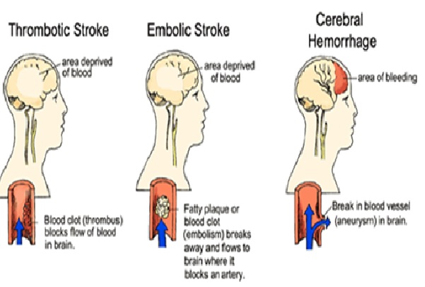 علائم و درمان كامل سكته مغزی خفيف و شديد سکته مغزی در اصطلاح پزشکی: cva مخفف چیست؟ Cerebro vascular accident or CVA سکته مغزی به انگلیسی استروک (Stroke) سکته مغزی خفیف یا گذرا (ایسکمیک( علائم و درمان سکته خفیف مغزی (TIA) دلایل سکته مغزی خفیف یا گذرا راه های درمان سکته مغزی گذرا کاردرمانی کاردرمانی سکته مغزی در خانه ورزشهای مخصوص سکته مغزی تاثیر کاردرمانی در سکته مغزی مرکز کاردرمانی سکته مغزی بهترین دکتر برای سکته مغزی در تهران بیمارستان تخصصی سکته مغزی در تهران بهترین مرکز درمان سکته مغزی توانبخشی بیماران سکته مغزی کاردرمانی بیماران سکته مغزی کاردرمانی در منزل بیمار سکته مغزی بهترین مرکز توانبخشی سکته مغزی بهترین دکتر برای سکته مغزی در تهران تمرینات کاردرمانی سکته مغزی مراقبت پرستاری cva مراقبت از بیمار سکته مغزی در منزل آب درمانی خارج کردن لخته خون تحریک الکتریکی مغز (TDCS) بهترین دارو برای بیماران سکته مغزی