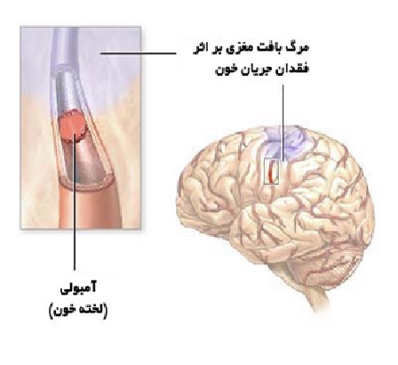 علائم و درمان كامل سكته مغزی خفيف و شديد
سکته مغزی در اصطلاح پزشکی: cva مخفف چیست؟
Cerebro  vascular accident or CVA
  سکته مغزی به انگلیسی  استروک (Stroke)
سکته مغزی خفیف یا گذرا (ایسکمیک(
علائم و درمان سکته خفیف مغزی (TIA)
دلایل سکته مغزی خفیف یا گذرا
راه های درمان سکته مغزی گذرا
کاردرمانی
کاردرمانی سکته مغزی در خانه
ورزشهای مخصوص سکته مغزی
تاثیر کاردرمانی در سکته مغزی
مرکز کاردرمانی سکته مغزی
بهترین دکتر برای سکته مغزی در تهران
بیمارستان تخصصی سکته مغزی در تهران
بهترین مرکز درمان سکته مغزی
توانبخشی بیماران سکته مغزی
کاردرمانی بیماران سکته مغزی
کاردرمانی در منزل بیمار سکته مغزی
بهترین مرکز توانبخشی سکته مغزی
بهترین دکتر برای سکته مغزی در تهران
تمرینات کاردرمانی سکته مغزی
مراقبت پرستاری cva
مراقبت از بیمار سکته مغزی در منزل
آب درمانی
خارج کردن لخته خون
تحریک الکتریکی مغز (TDCS)
بهترین دارو برای بیماران سکته مغزی
